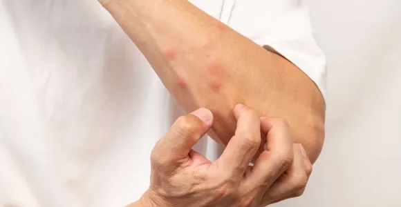 man krabt aan insectenbeten op arm