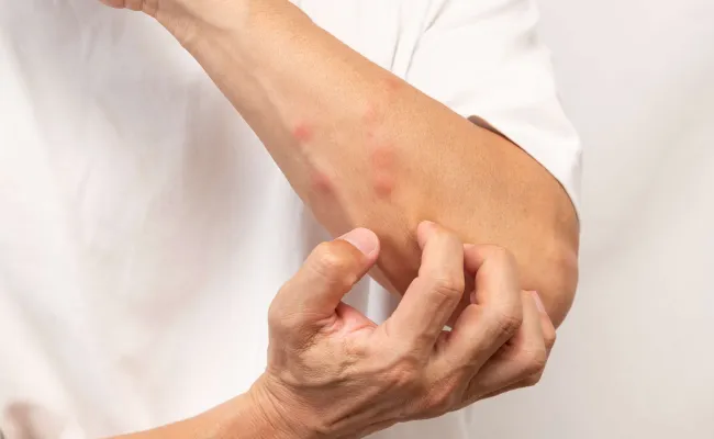 man krabt aan insectenbeten op arm